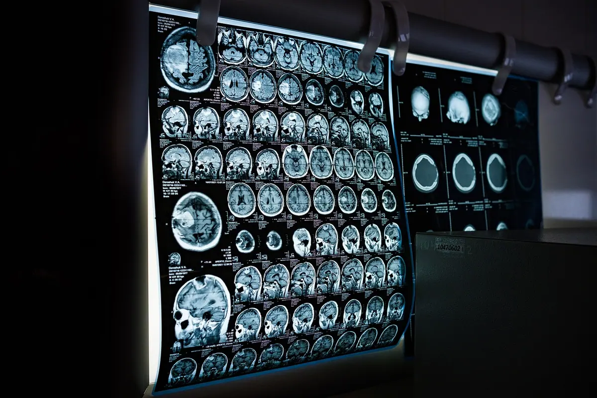 Radiografii și imagini de rezonanță magnetică ale creierului, pe un panou luminos