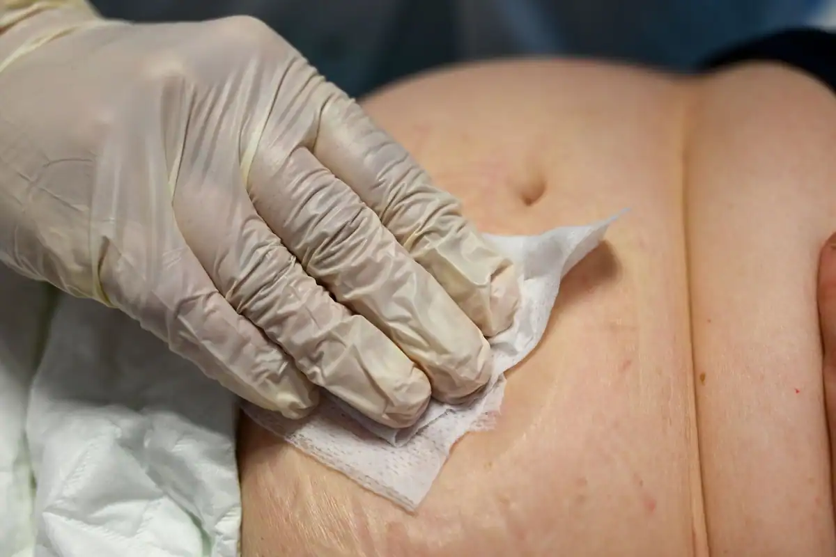 Mână cu mănușă curăță cu un șervețel zona cusăturii de pe abdomen